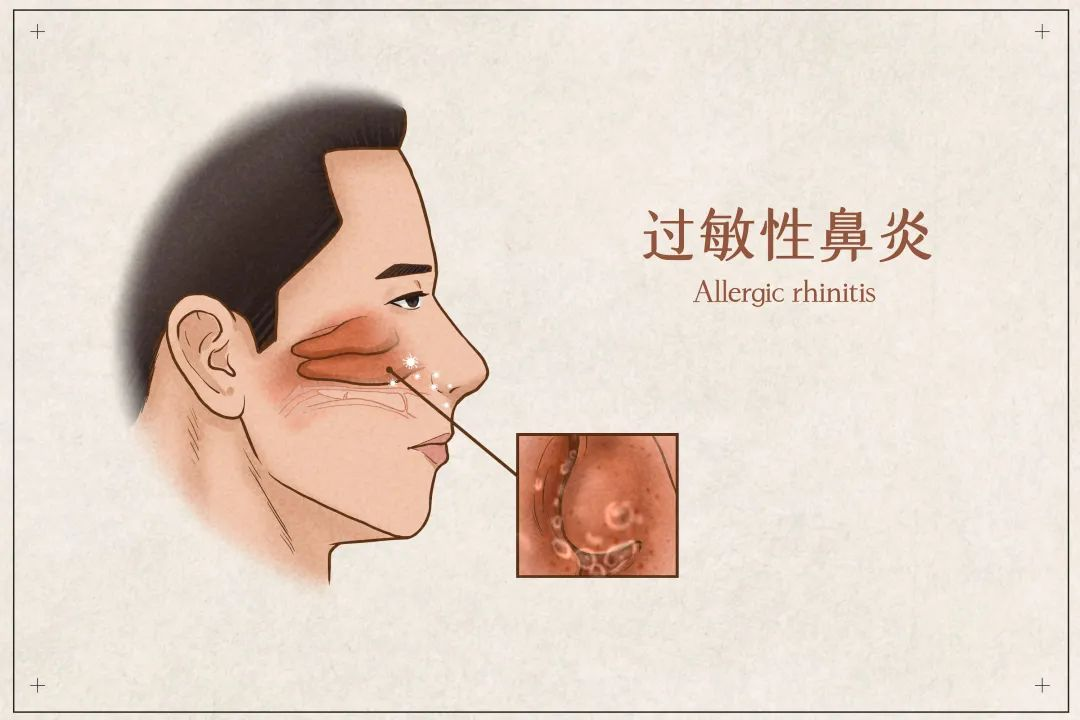 中药治疗寒性鼻炎，谷医堂谷方益元胡耀飞医师有妙招！